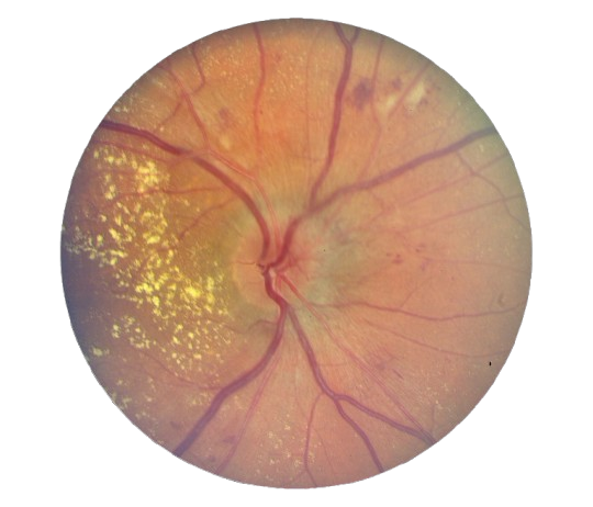 Hypertension retinopathy retinal biomarker scan