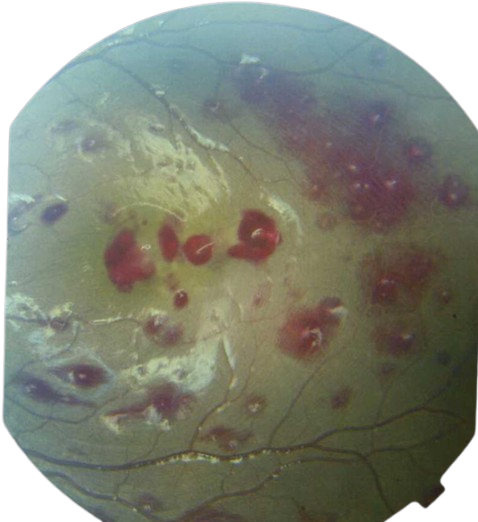 Malaria retinopathy retinal biomarker scan