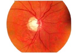 Parkinson's disease retinal biomarker scan